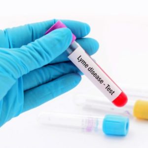 Identifying and Assessing Lyme Disease in Naturopathic Patients