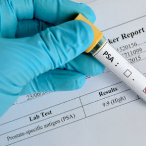 PSA Testing and Emerging Alternatives